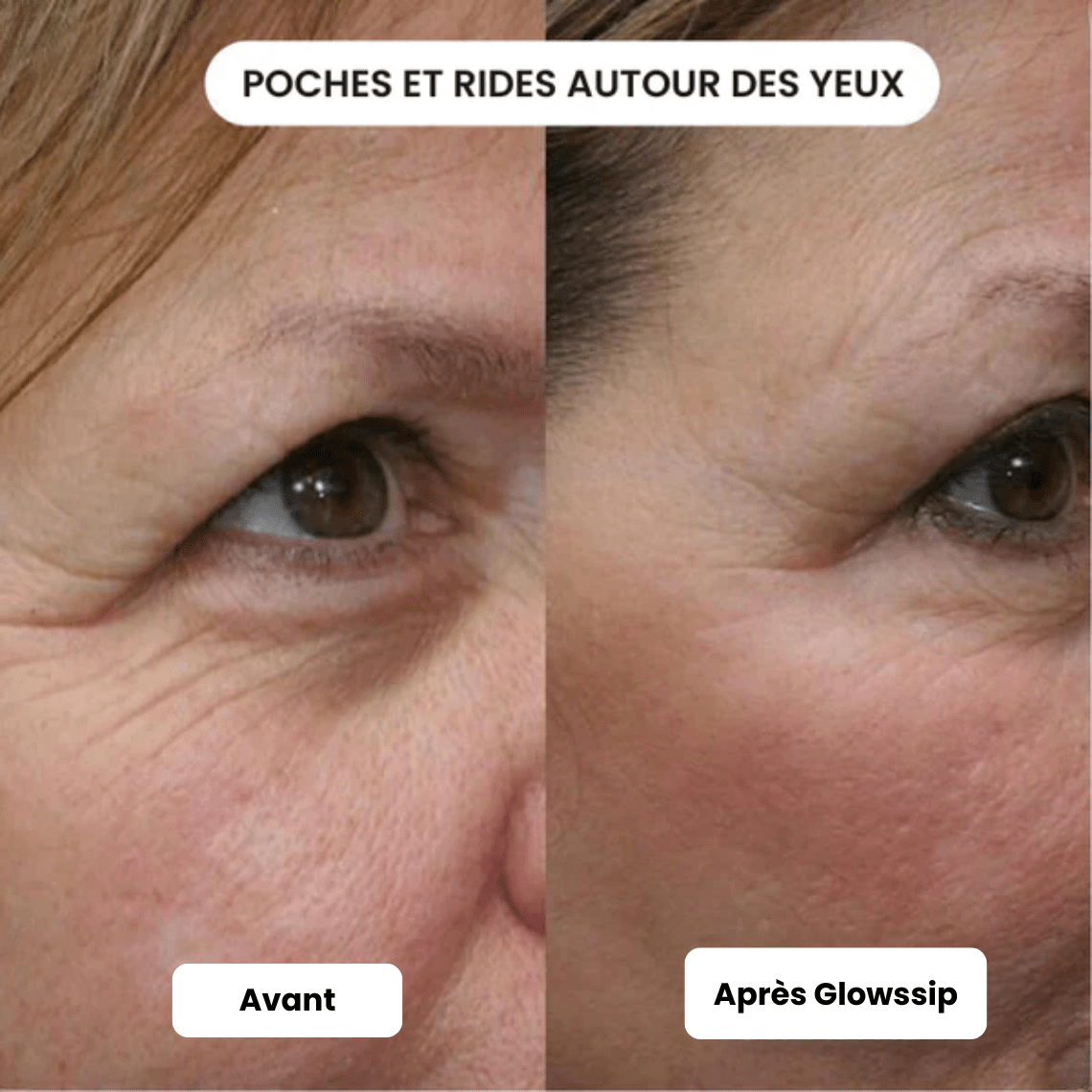 Micro Infusion 3 Mois + 2 Cadeaux Offerts