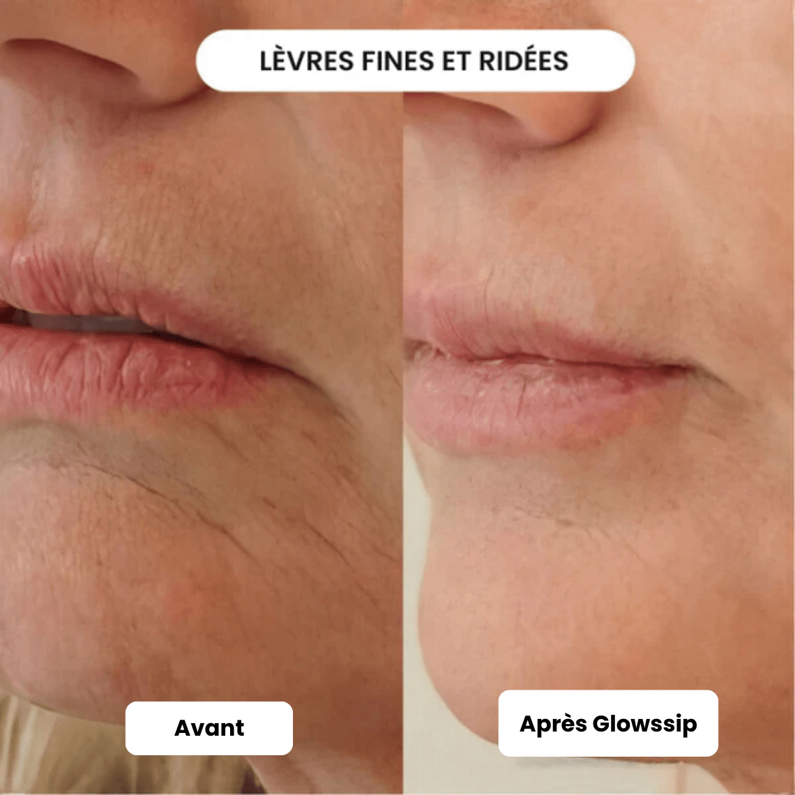 Micro Infusion 3 Mois + 2 Cadeaux Offerts