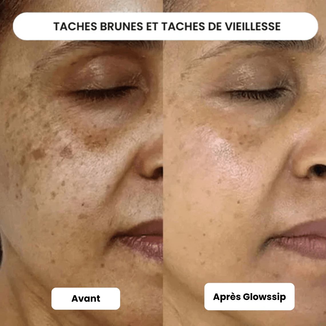 Micro Infusion 3 Mois + 2 Cadeaux Offerts