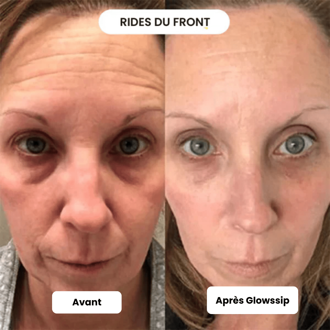 Micro Infusion 3 Mois + 2 Cadeaux Offerts