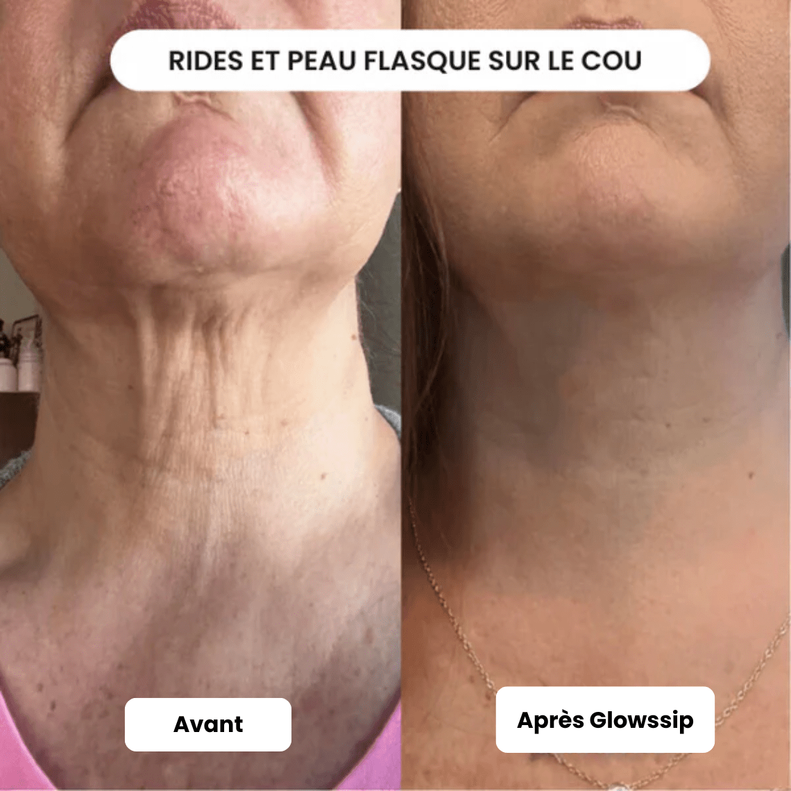 Micro Infusion 3 Mois + 2 Cadeaux Offerts