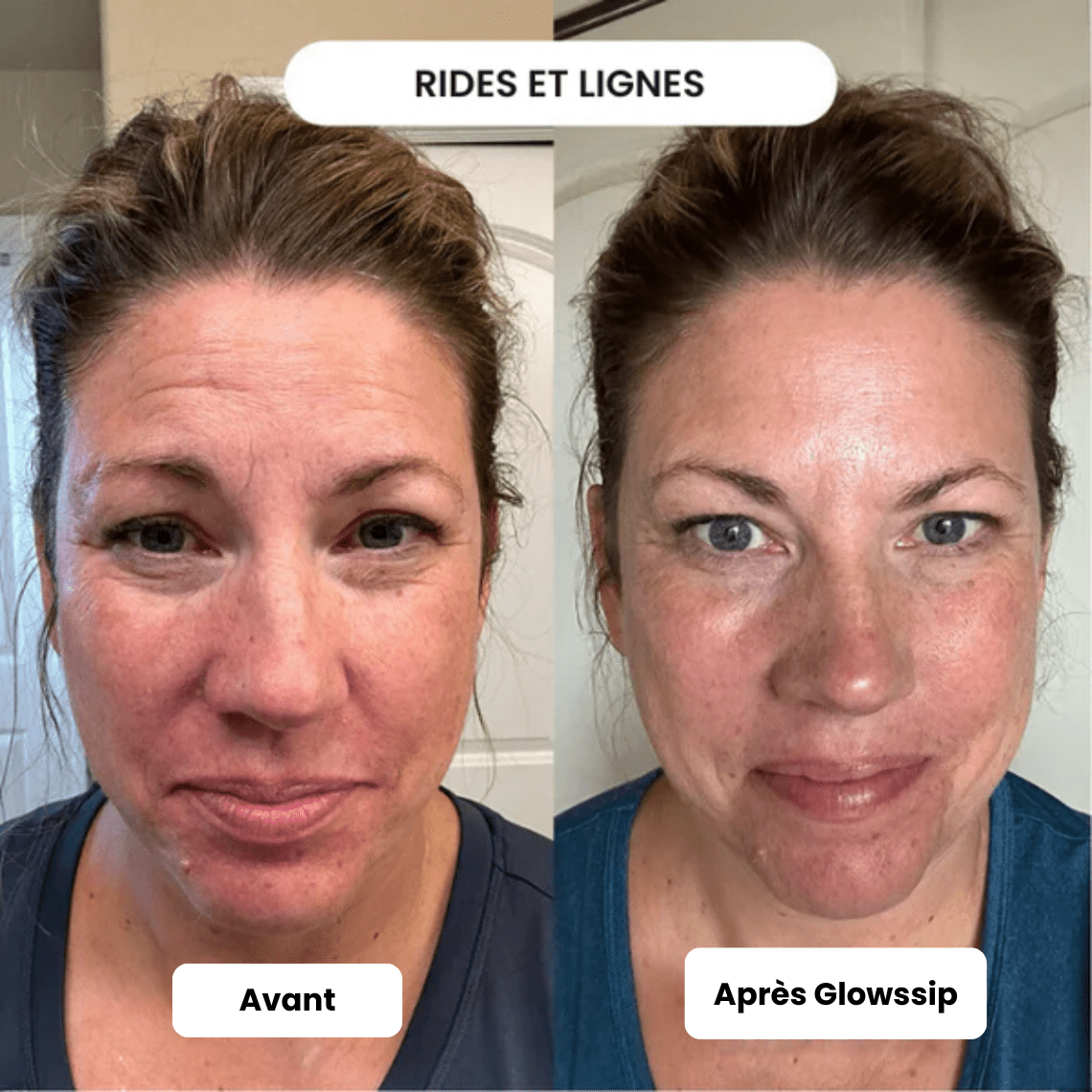 Micro Infusion 3 Mois + 2 Cadeaux Offerts