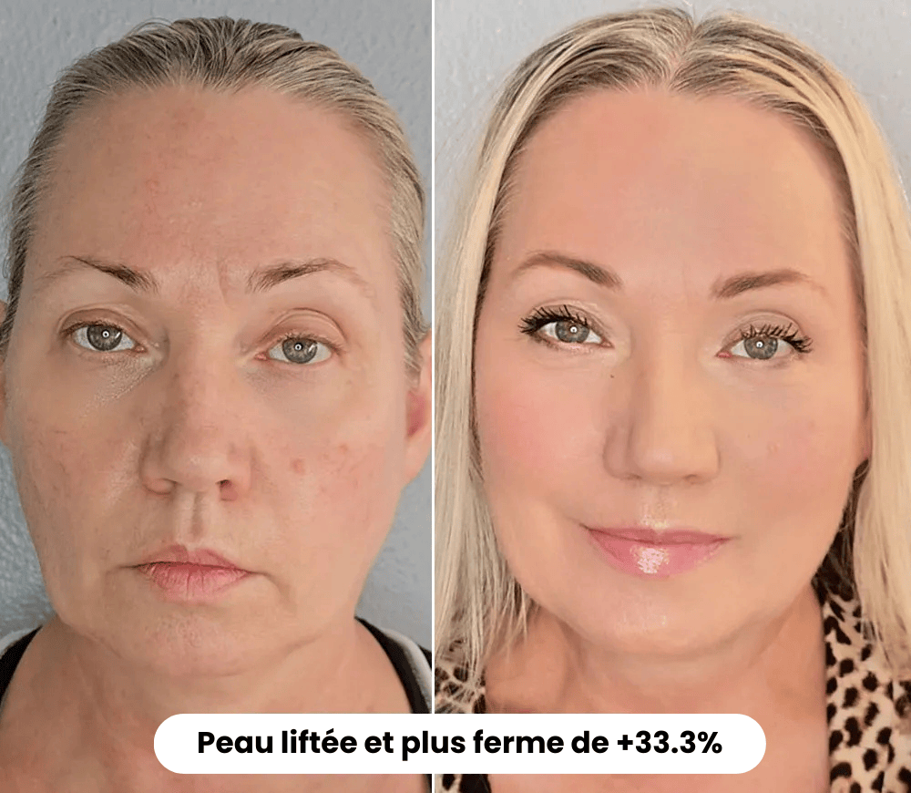 Micro Infusion: -65% +4 Cadeaux Offerts Aujourd&
