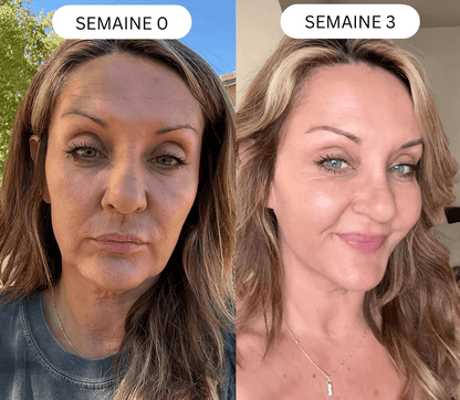 Micro Infusion 3 Mois + 2 Cadeaux Offerts